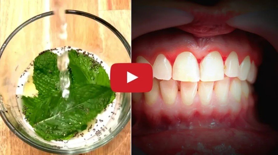 How to Treat Gum Disease Video